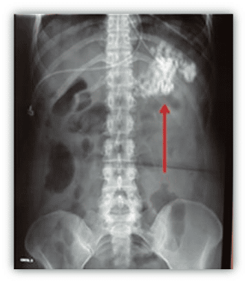 The Impact of Calcium Containing Medications on Abdominal X Ray Imaging  